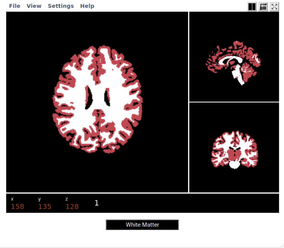 In-browser 3D MRI segmentation: brainchop.org